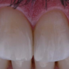 Diş çekimi sonrasında implant mutlaka gerekli mi?
